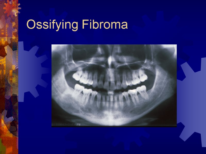 Ossifying Fibroma